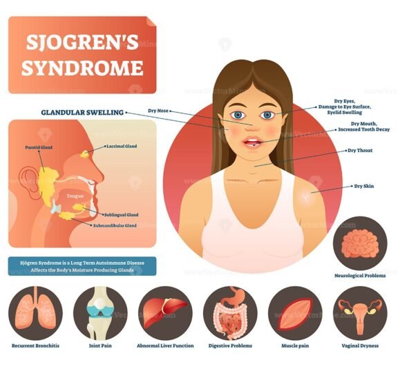 Sjogrens Syndrome