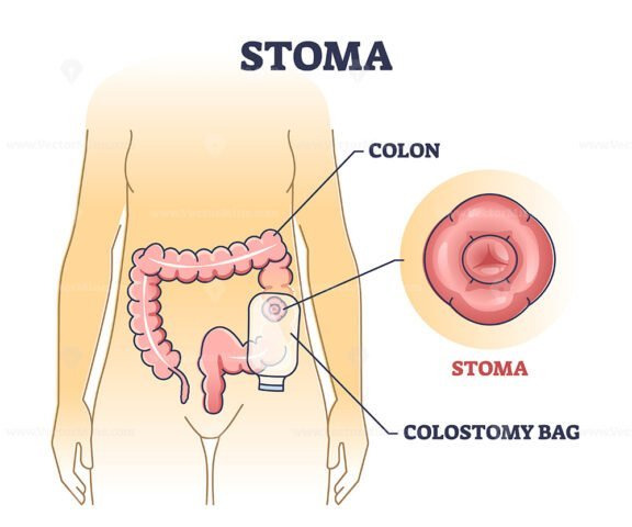 Stoma outline Diagram