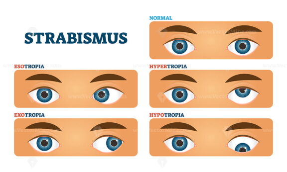 Strabismus