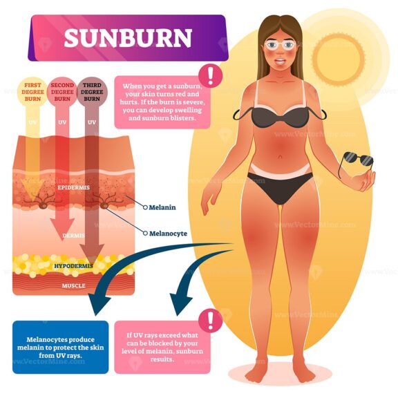 Sunburn vector illustration