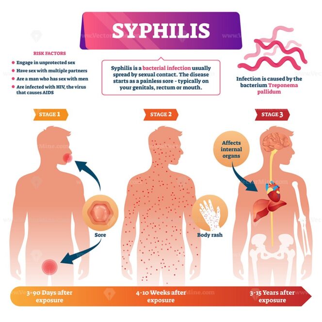 Syphilis vector illustration - VectorMine