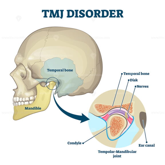 TMJ disorder