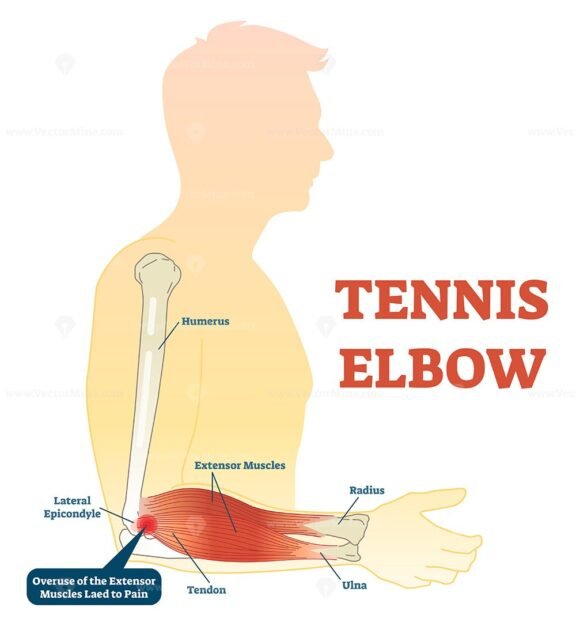 Tennis Elbow