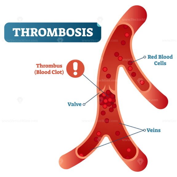 Thrombosis