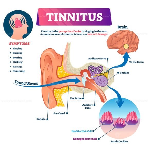 Tinnitus