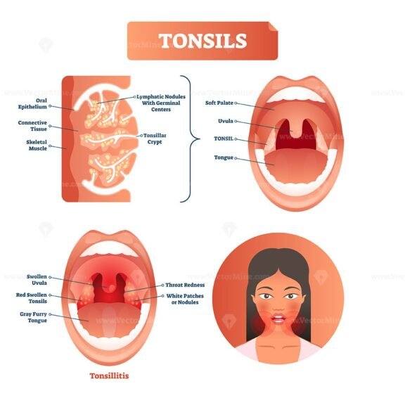 Tonsils