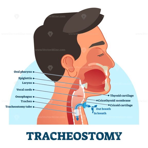 Tracheostomy