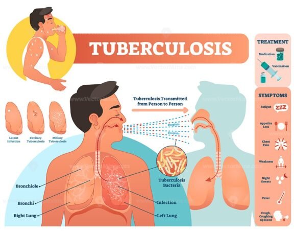 Tuberculosis