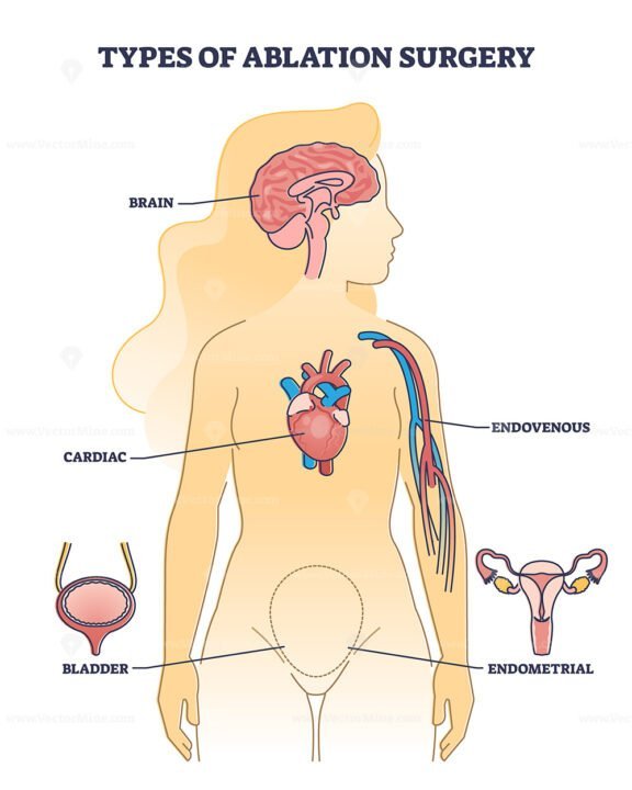 Types of Ablation Surgery outline