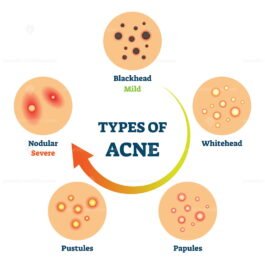 Types of acne as medical skin disease comparison scheme vector ...