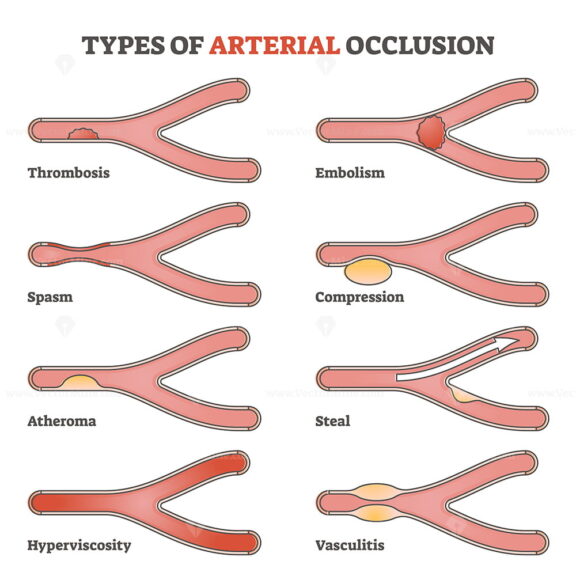 Types of arterial occlusion and circulatory flow disorders outline diagram