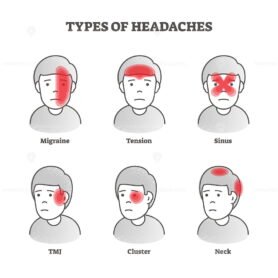 FREE Types of headaches vector illustration – VectorMine
