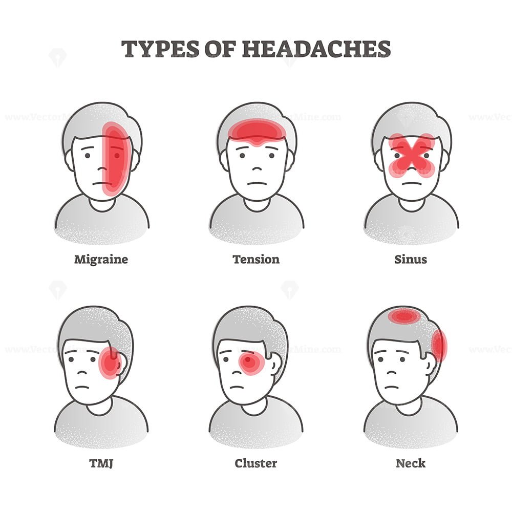 Types Of Headaches Set Of Headache Types Stock Vector - vrogue.co