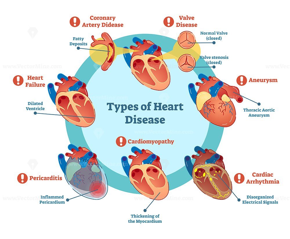 Types of heart disease collection – VectorMine