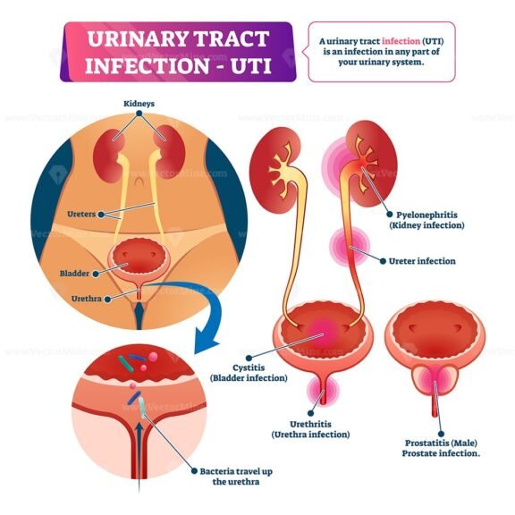 UTI Urinary tract infection