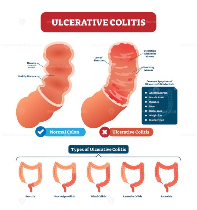 Ulcerative Colitis As Chronic Inflammatory Bowel Disease Outline Diagram Vectormine 3773