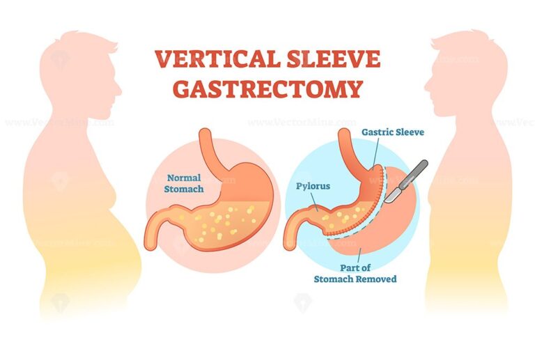 Vertical Sleeve Gastrectomy medical vector illustration – VectorMine