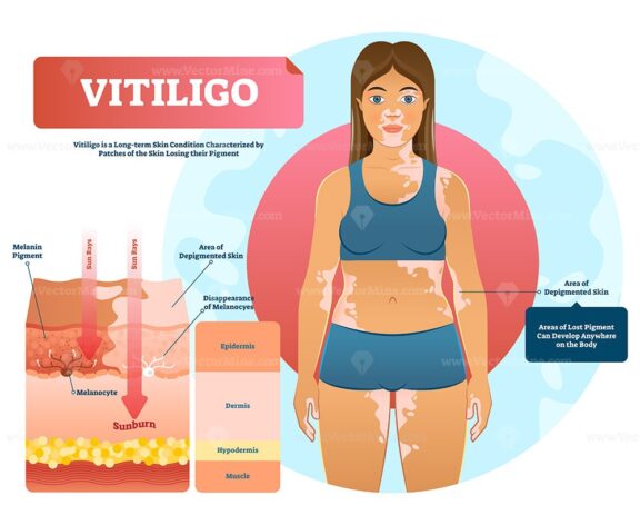 Vitiligo vector illustration