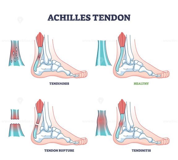 Achilles tendon injury types as leg or ankle trauma examples outline ...