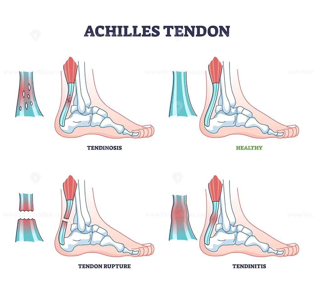 Achilles Tendon Injury Types As Leg Or Ankle Trauma Examples Outline ...