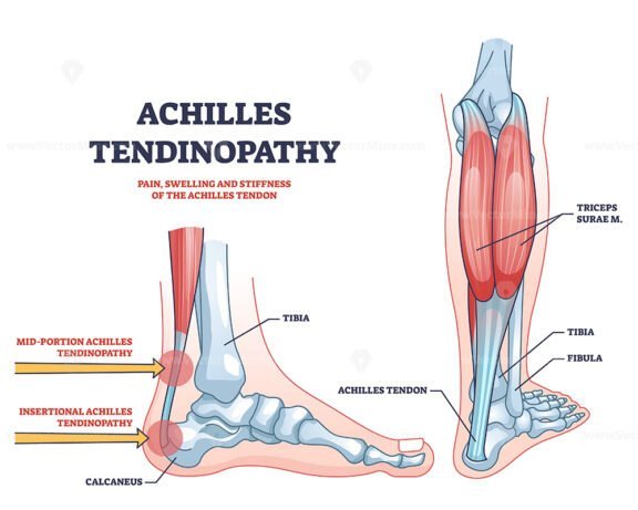Achilles tendon rupture as painful injury and leg trauma outline ...