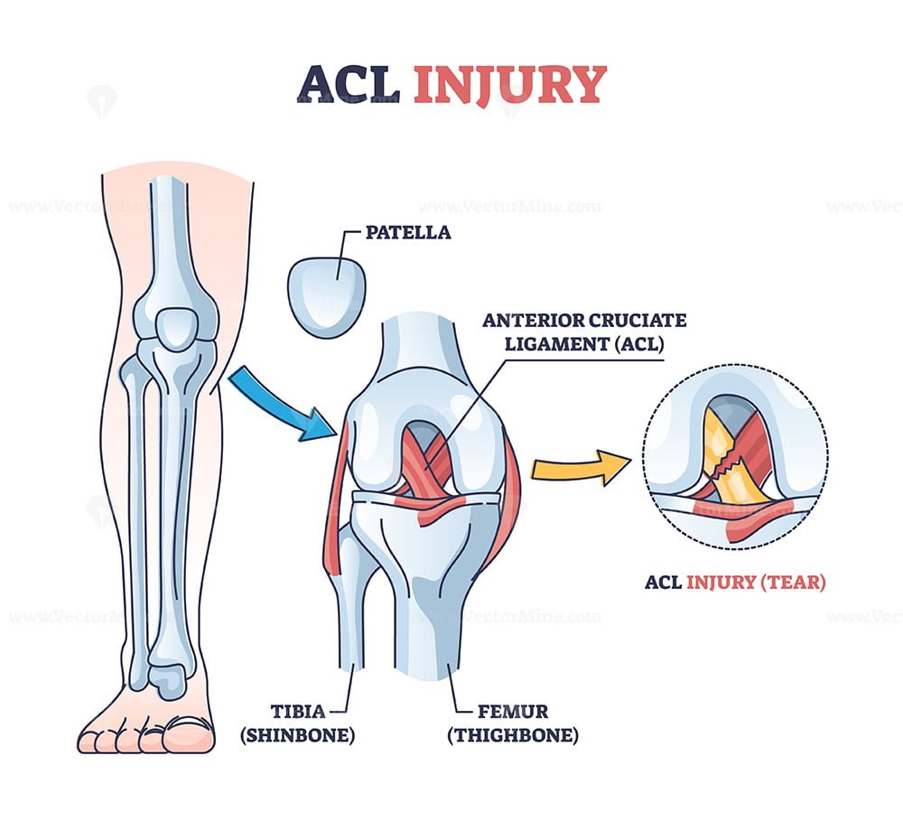 ACL injury or trauma as tear or sprain of anterior cruciate outline
