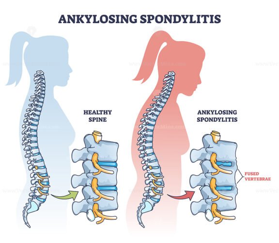 Ankylosing spondylitis as inflammatory spine bone disease outline diagram