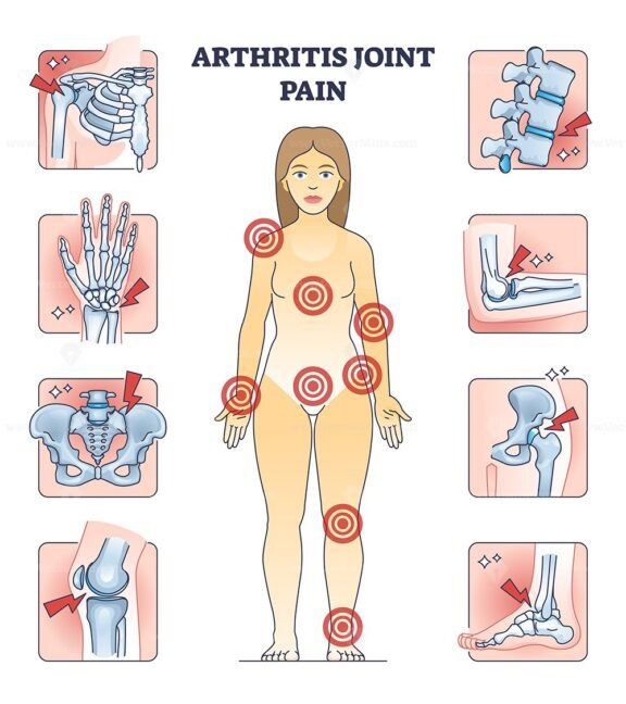 arthritis joint pain outline 1