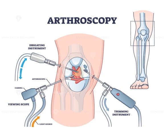 arthroscopy outline diagram 1