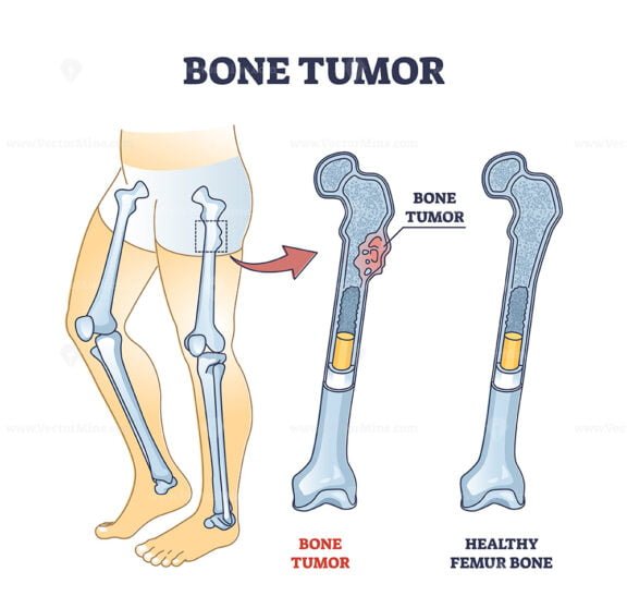 bone tumor outline 1