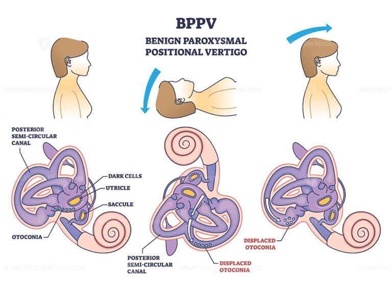 BPPV Or Benign Paroxysmal Positional Vertigo Syndrome Outline Diagram ...