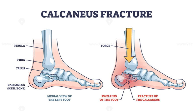 Calcaneus fracture anatomy with broken heel bone structure outline ...