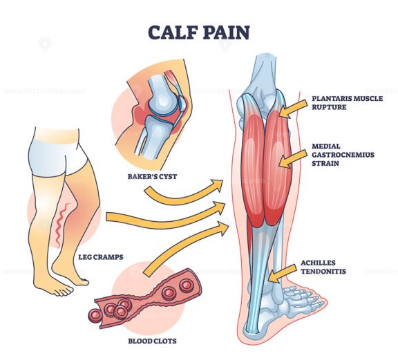 calf-pain-explanation-with-cramp-from-muscle-contraction-outline