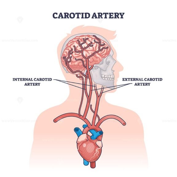 carotid artery outline 1