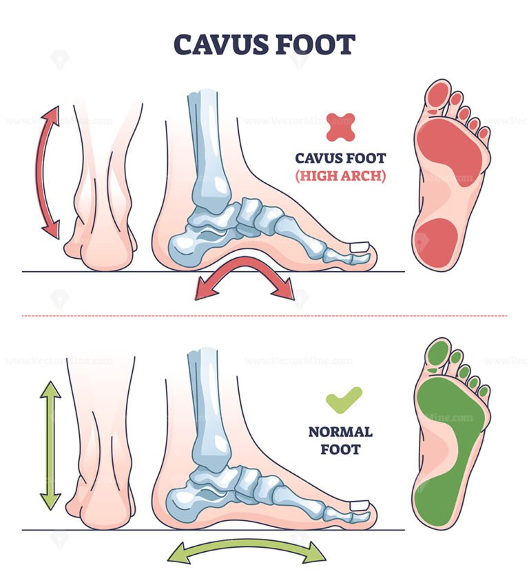 Cavus Foot With Abnormal High Arch Condition To Feet Bones Outline ...