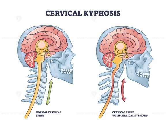 cervical kyphosis outline 1