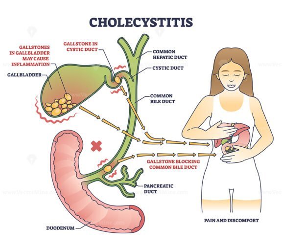 Ulcerative Colitis As Chronic Inflammatory Bowel Disease Outline Diagram Vectormine 4513