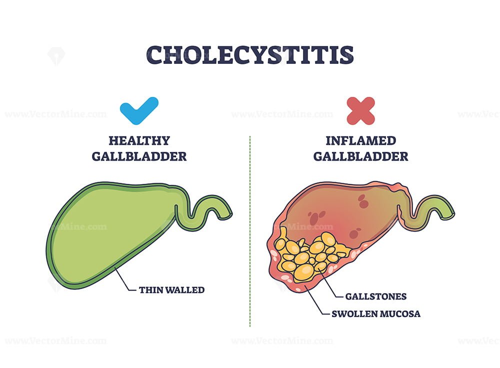Cholecystitis as inflamed gallbladder compared with healthy outline ...