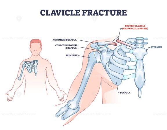 clavicle fracture outline 1