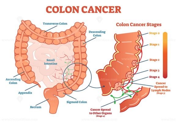 Colon cancer medical vector illustration – VectorMine