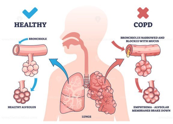 copd v2 outline diagram 1