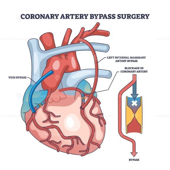 coronary artery bypass surgery outline diagram 1