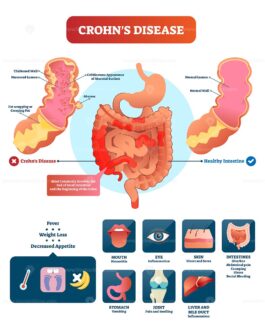 Crohns disease vector illustration – VectorMine