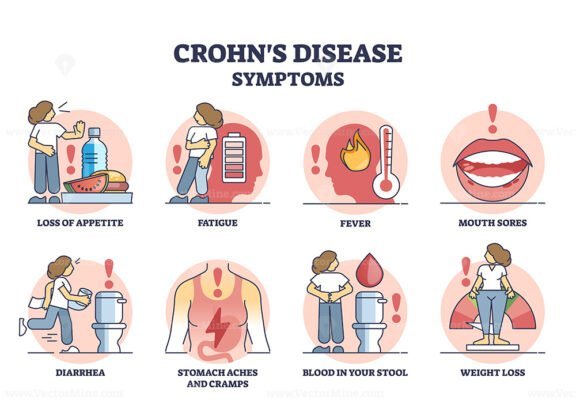 Inflammatory Bowel Disease Or Ibd With Crohns And Colitis Outline Diagram Vectormine 0868