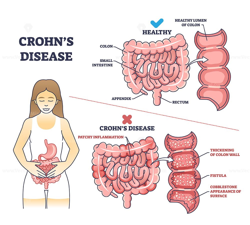 Crohns Disease As Inflammatory Bowel Problem Explanation Outline Diagram Vectormine 7089