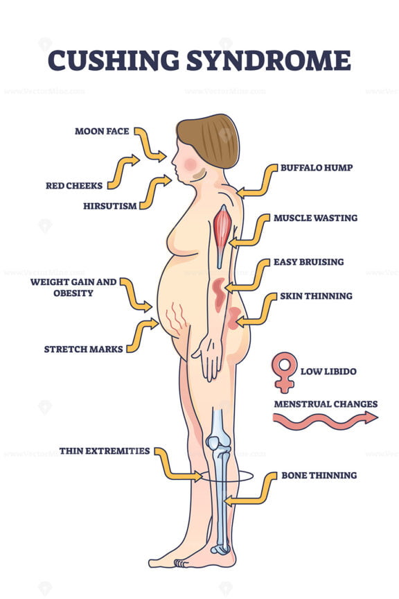 Cushing syndrome symptoms list from high cortisol level outline diagram