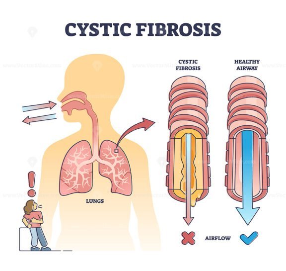 cystic fibrosis outline diagram 1