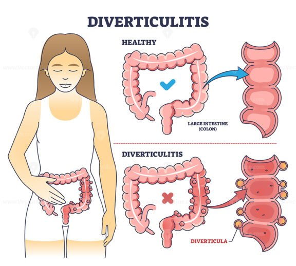 diverticulitis v2 outline 1