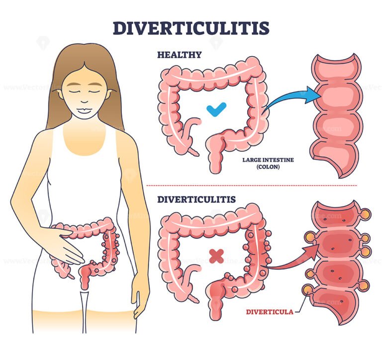 Inflammatory bowel disease or IBD with Crohns and colitis outline ...