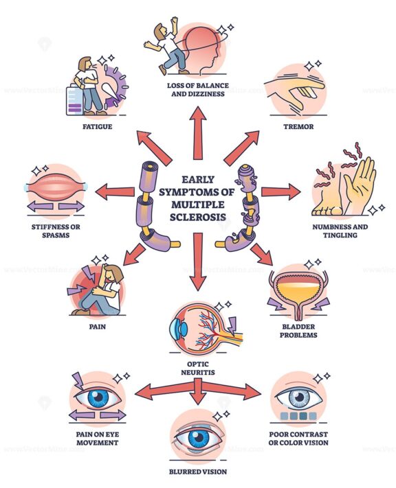 Early symptoms of multiple sclerosis and MS affected things outline diagram